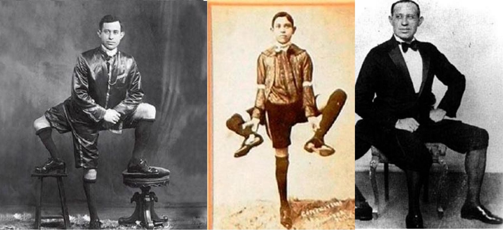 Al momento stai visualizzando Frank Lentini: l’uomo con tre gambe che fece della sua anomalia un’arte
